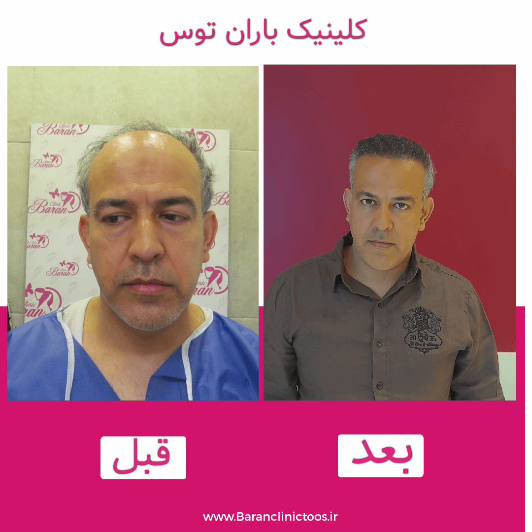 قبل و بعد کاشت مو